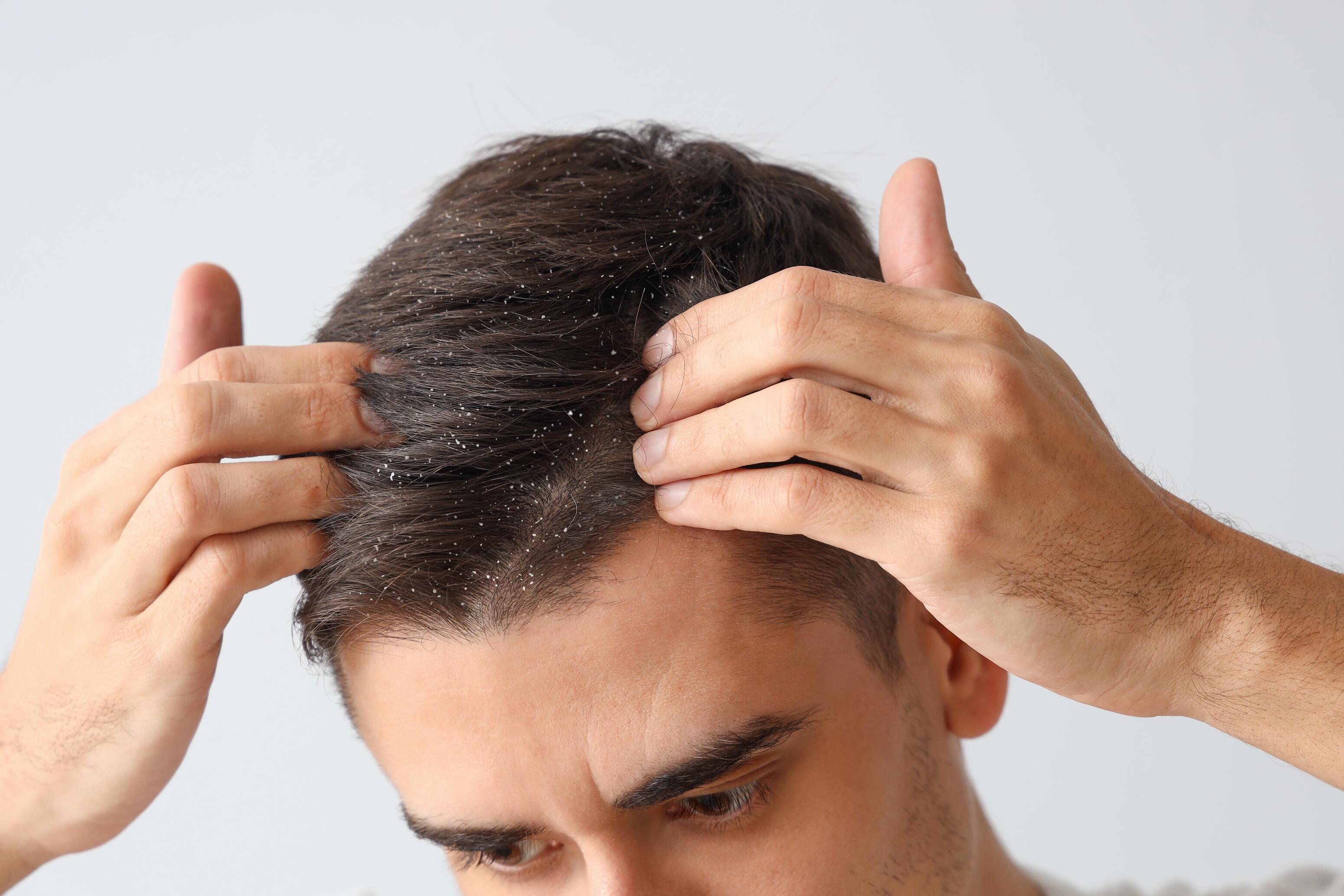 Dermite séborrhéique sur les cheveux